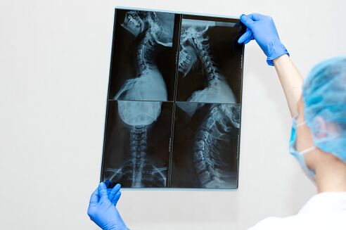 Osteohondroza hrbtenična bolezen
