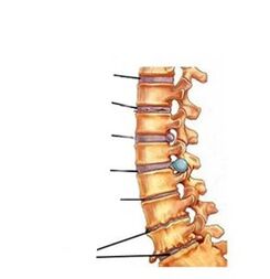 stopnje razvoja osteohondroze