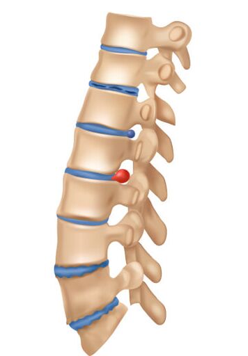 Kako izgleda deophrming osteohondroza
