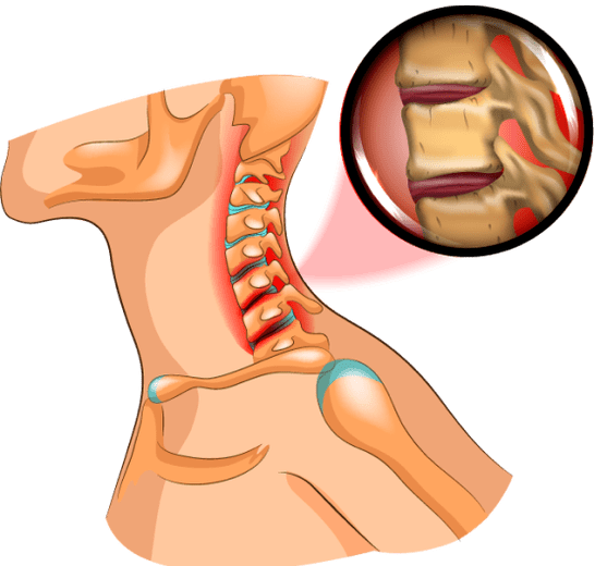 osteohondroza v vratu